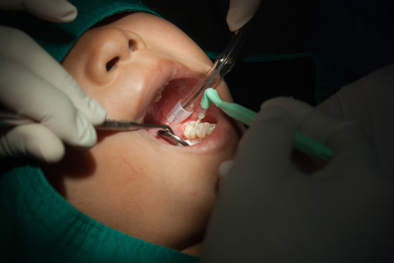Sealants